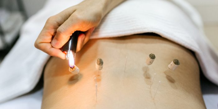 moxibustion